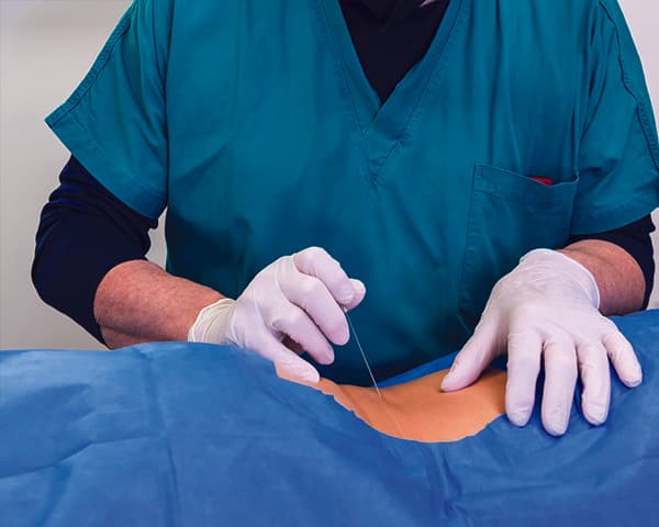 Infiltration de la racine nerveuse ou périradiculaire