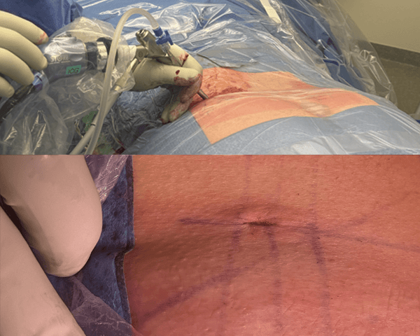 Endoscopie spinale